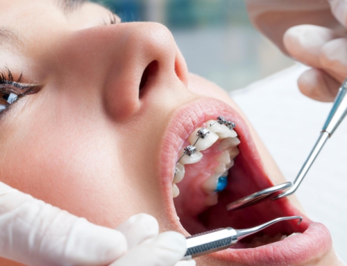 Diş teli tedavisi nasıl yapılır? Tedavi sırasında nelere dikkat edilmeli?